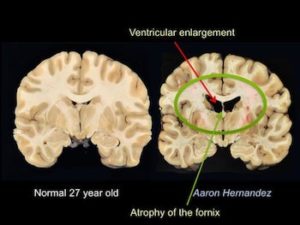 Image comparing Aaron Hernandez’s brain to a normal brain, showing physical evidence of traumatic brain injury.