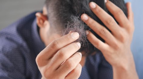 Man experiencing hair loss.