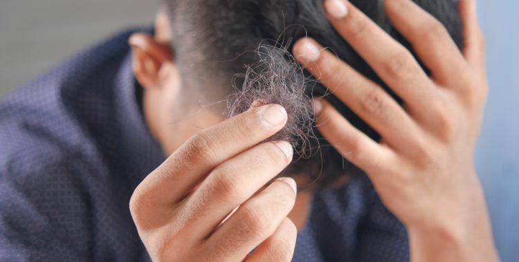 Man experiencing hair loss.
